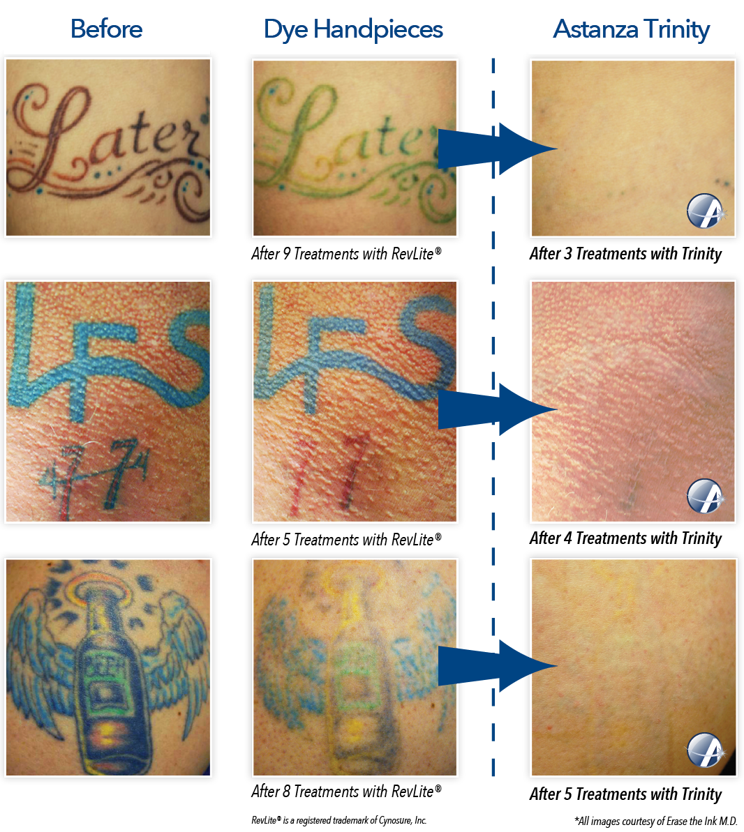 Tattoo Removal Before &amp; After Photos from Astanza