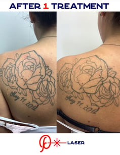 laser tattoo removal easton pa precision laser