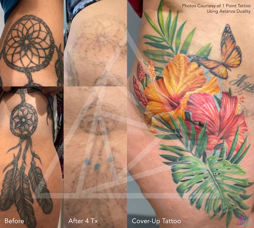 1 Point Tattoo Before and after laser tattoo removal