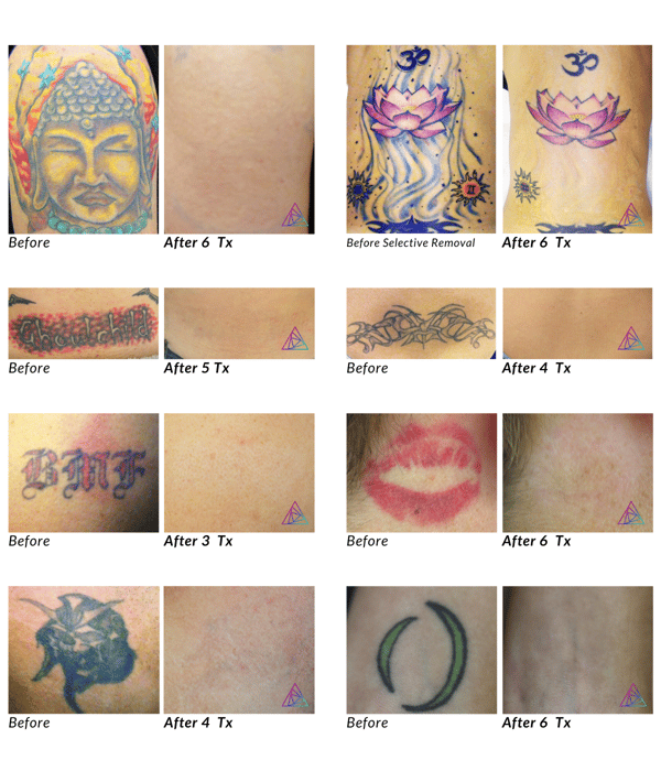 Astanza Before and After Laser Tattoo Removal Photos