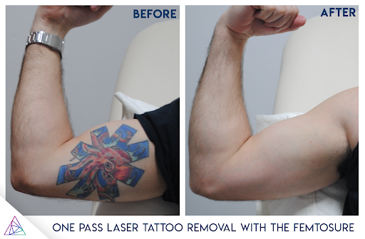 The Fastest Laser Tattoo Removal Laser EVER The