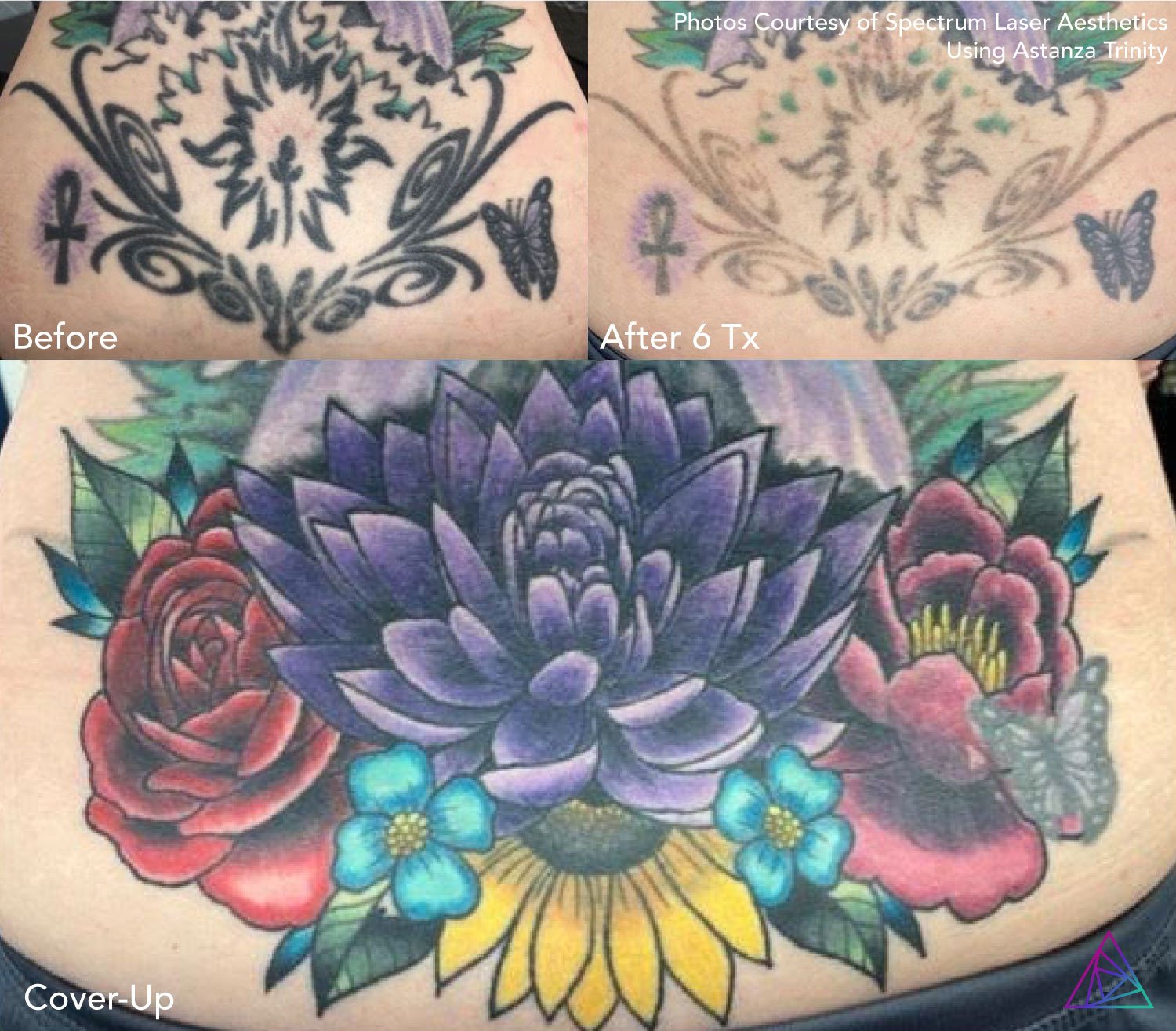 Delete Tattoo Removal  Medical Salon  Who says lasers cant remove purple  and pink inks  At Delete our physicians use the PicoWay laser to remove  tattoos of all shapes colors