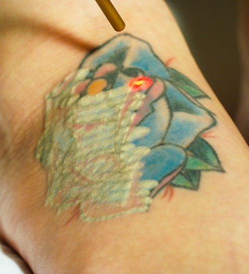 My 1st Two Tattoo Removal Sessions  Dani Hampton