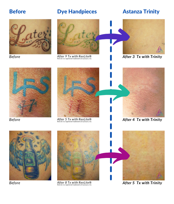 Astanza Before and After Laser Tattoo Removal Photos