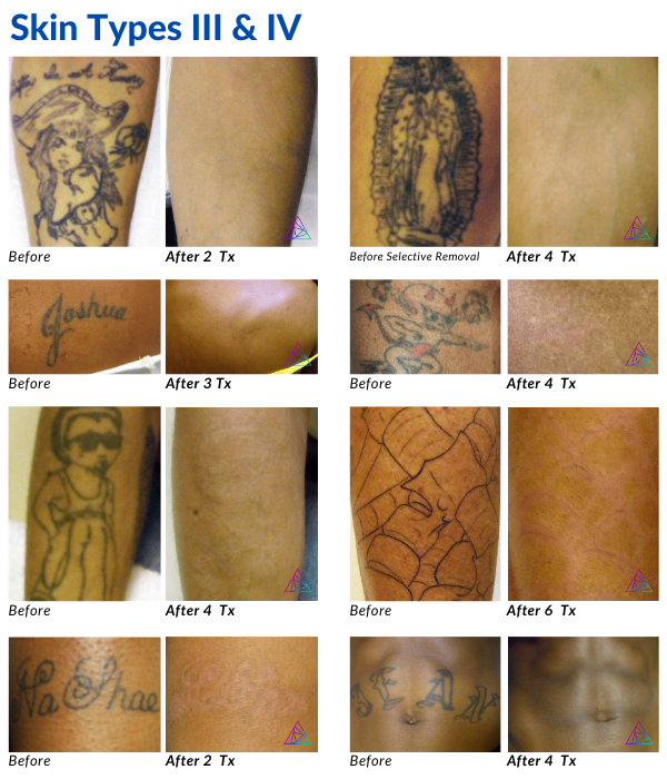 Laser Tattoo Removal - Full Experience - YouTube