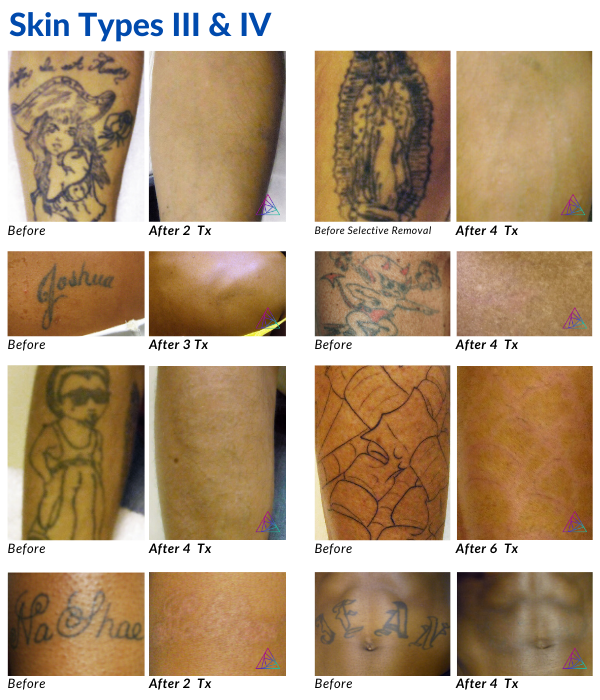 Astanza Before and After Laser Tattoo Removal Photos