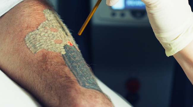 adding tattoo removal to your existing practice adding tattoo removal to your existing practice