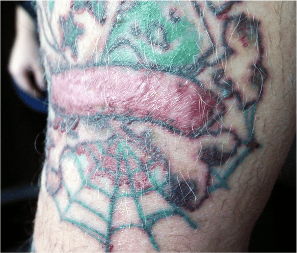 Non-Laser Tattoo Removal