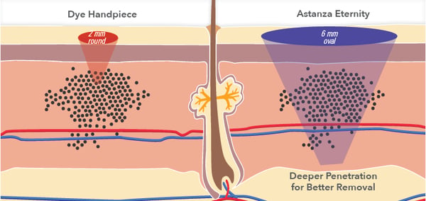 Tattoo-Removal-Laser-Treatment-Penetration