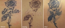a tetoválás eltávolítása a tetoválás fedezésére