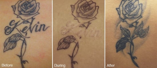 Image result for tattoo removal scar