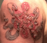 a lézeres tetoválás eltávolításából származó hólyagok