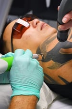 é a remoção de tatuagem a laser dolorosa