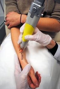 Insurance for Laser Tattoo Removal Clinic