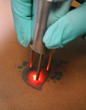 laser tattoo removal numbing for pain