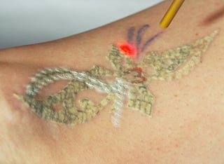 the pfd patch changing laser tattoo removal the pfd patch changing laser tattoo removal