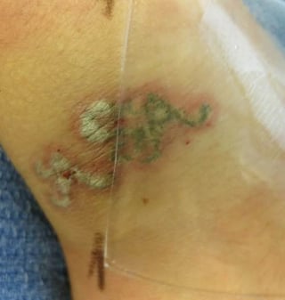the pfd patch changing laser tattoo removal the pfd patch changing laser tattoo removal