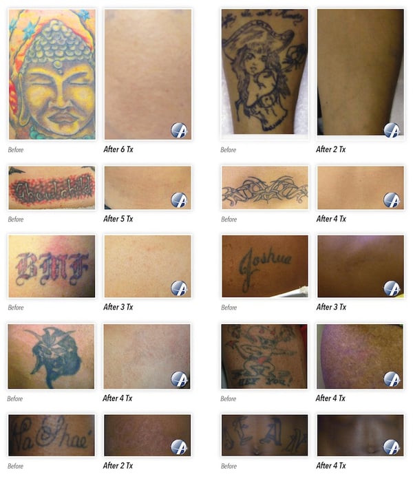 Tattoo Removal Laser Before and After