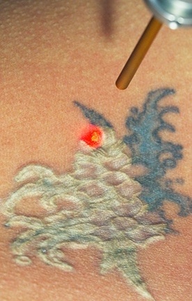 All About the R20 Method of Laser Tattoo Removal
