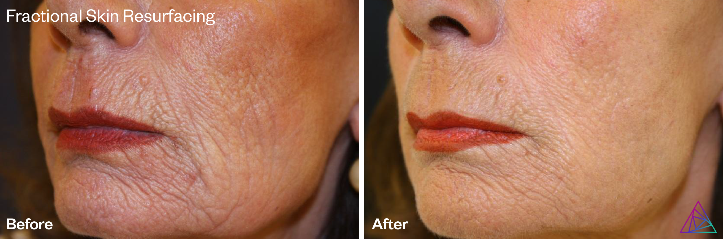 Fractional Skin Resurfacing by Astanza Laser