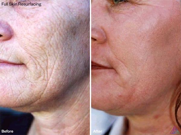 DermaBlate-BA_full-skin-resurfacing