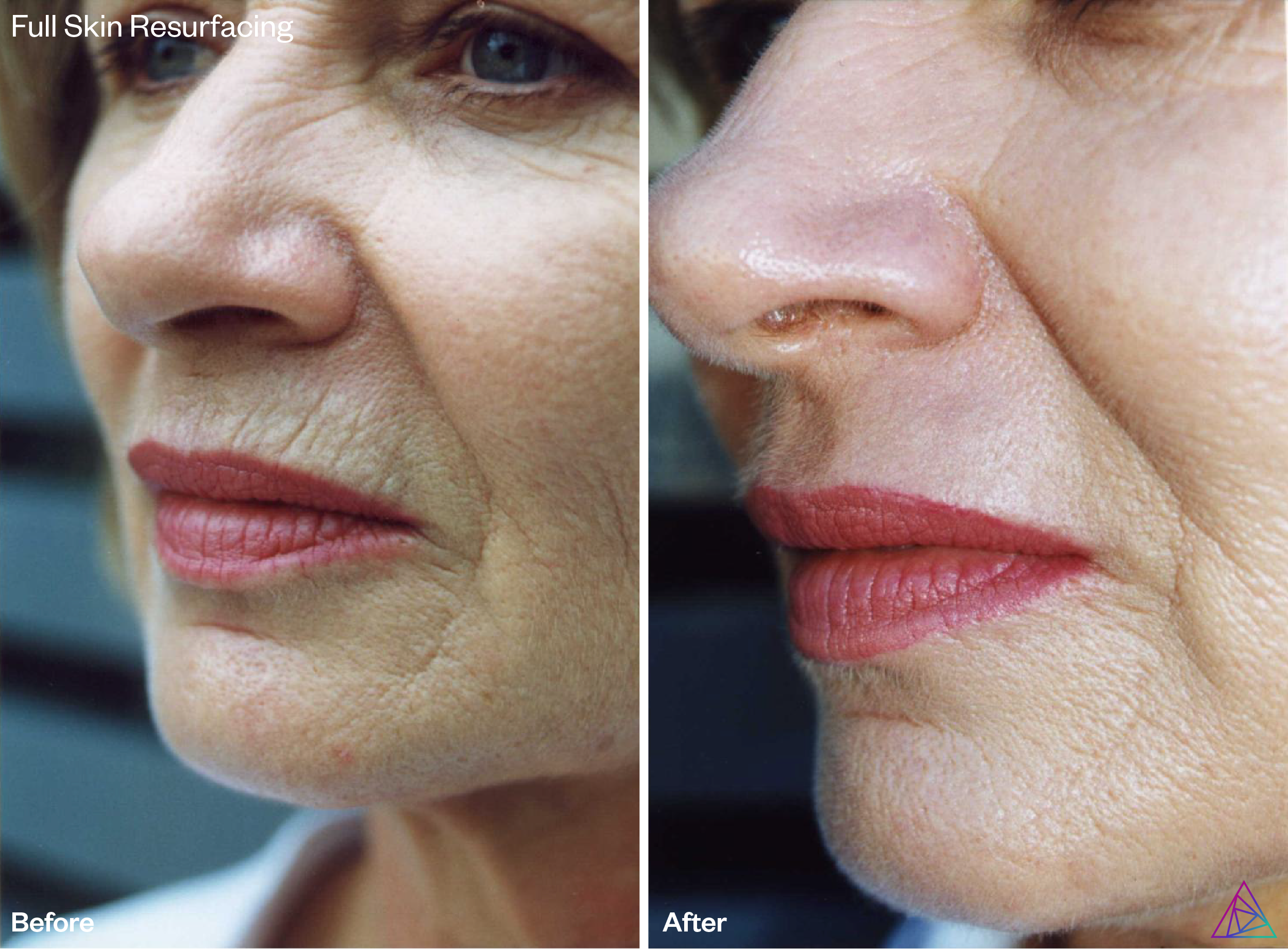 erbium laser resurfacing