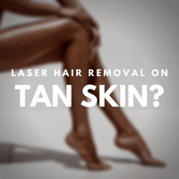 Does laser hair removal really work on tan skin_ 