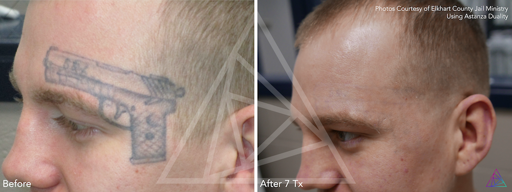 Laser Tattoo Removal Before And After Photos