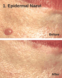 Epidermal Naevi - Astanza DermaBlate