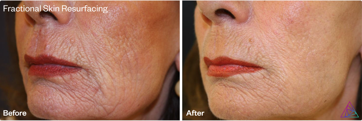 Fractional Skin Resurfacing with the Astanza DermaBlate