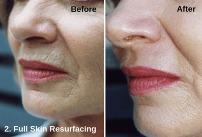 Full Skin Resurfacing - Astanza DermaBlate 2