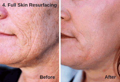 Full Skin Resurfacing - Astanza DermaBlate 4