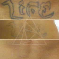Tattoo Removal Before and After Photo by Astanza Laser