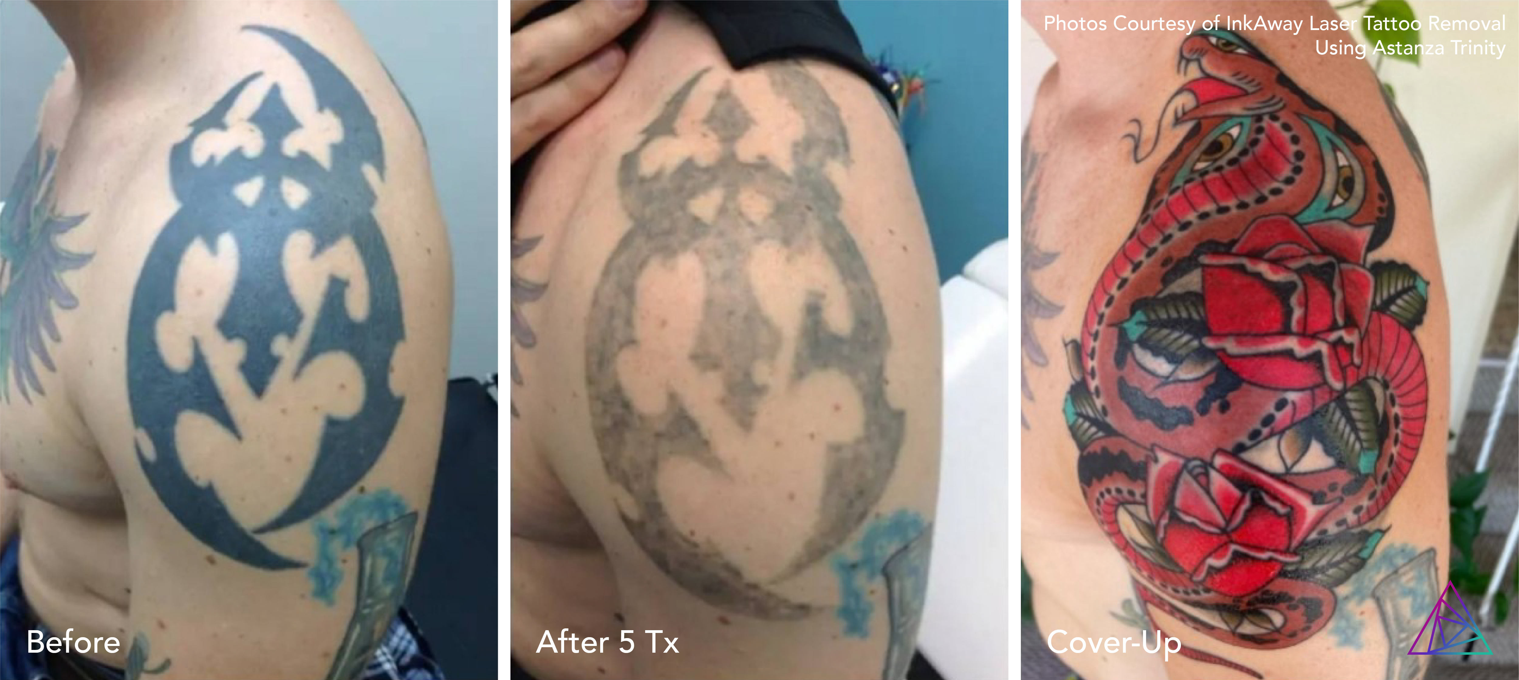 Vol 1 Top 10 Before  After Tattoo Removal Results  Removery