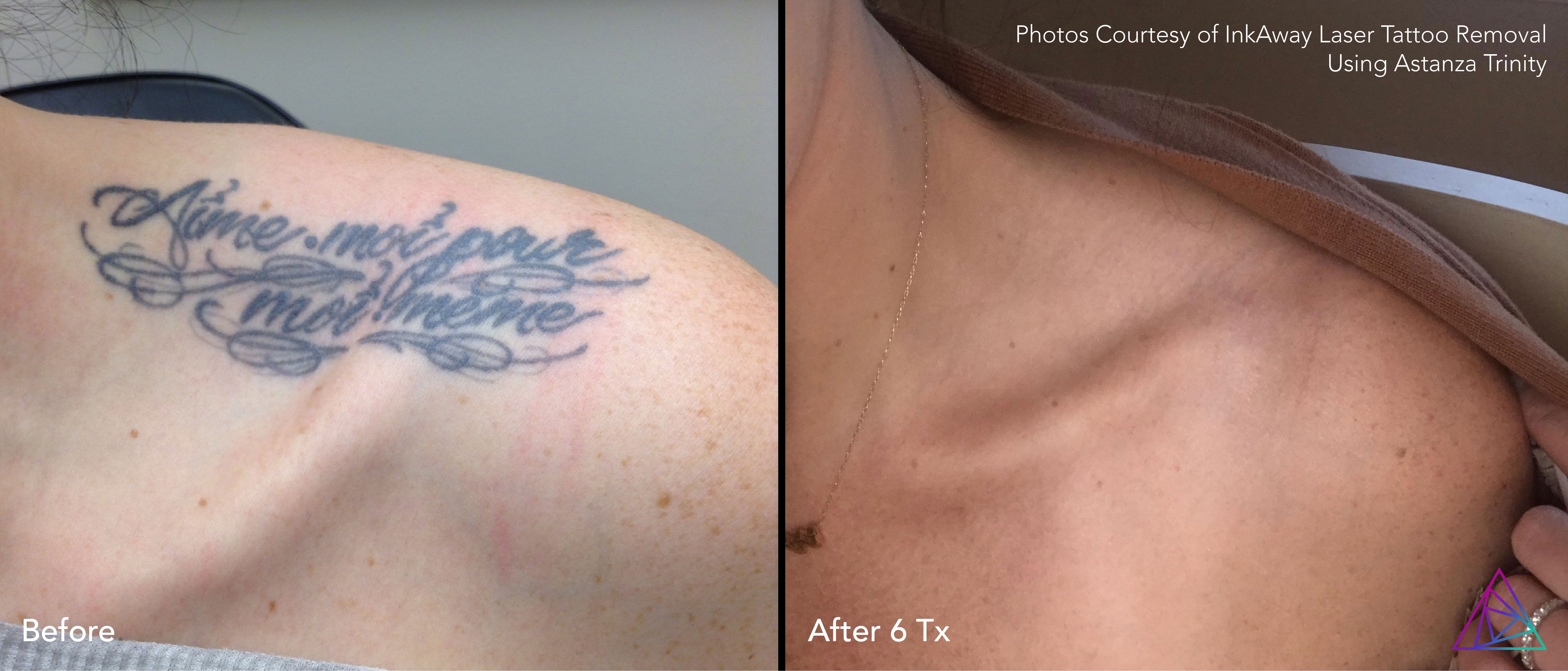 Picosure Tattoo Removal Before and After❤️Laser vs Non Laser