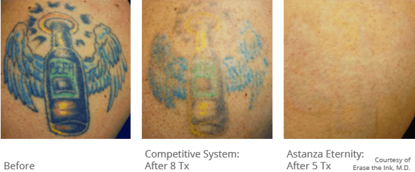 Laser Tattoo Removal with the Astanza Trinity