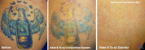 Laser Tattoo Removal by Astanza Laser