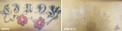 Laser Tattoo Removal by Astanza Laser