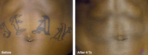 Laser Tattoo Removal by Astanza Laser