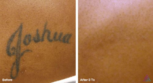 Laser Tattoo Removal by Astanza Laser