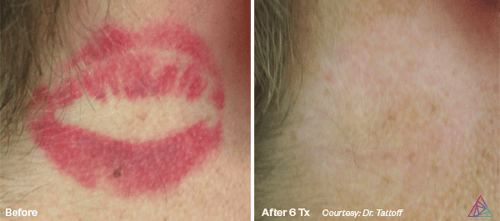 Laser Tattoo Removal by Astanza Laser