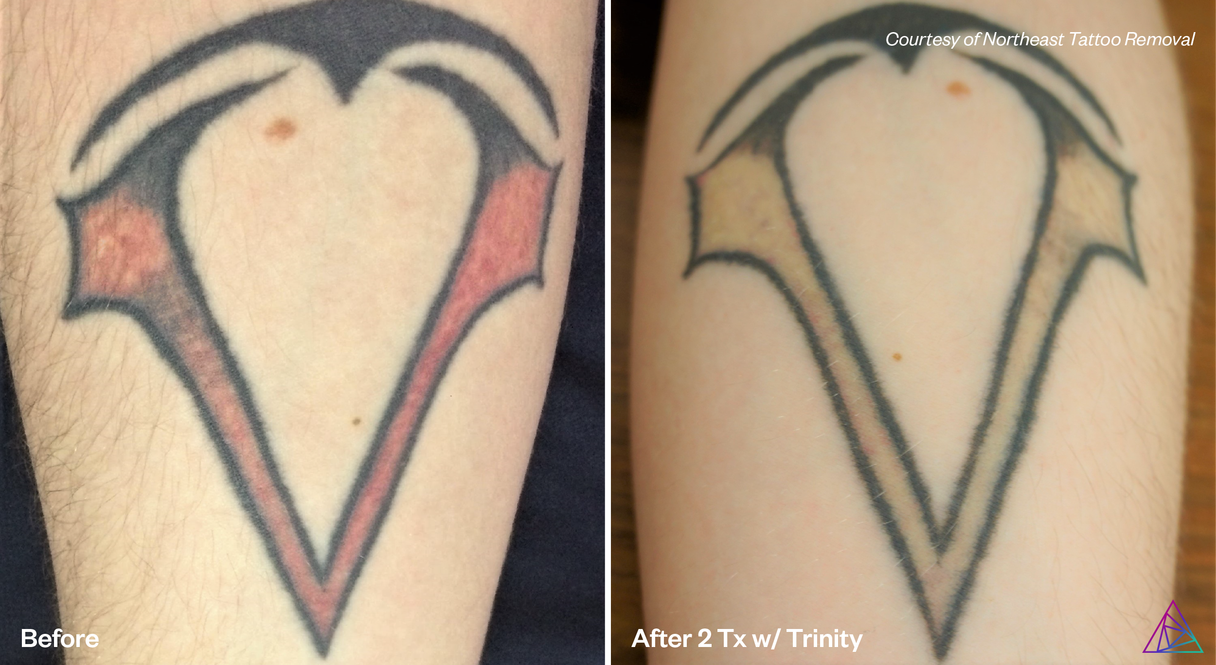 Northeast Tattoo Removal B&A-01