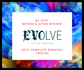 Q2 2019 Before & after winner - Best Compete Tattoo Removal-1