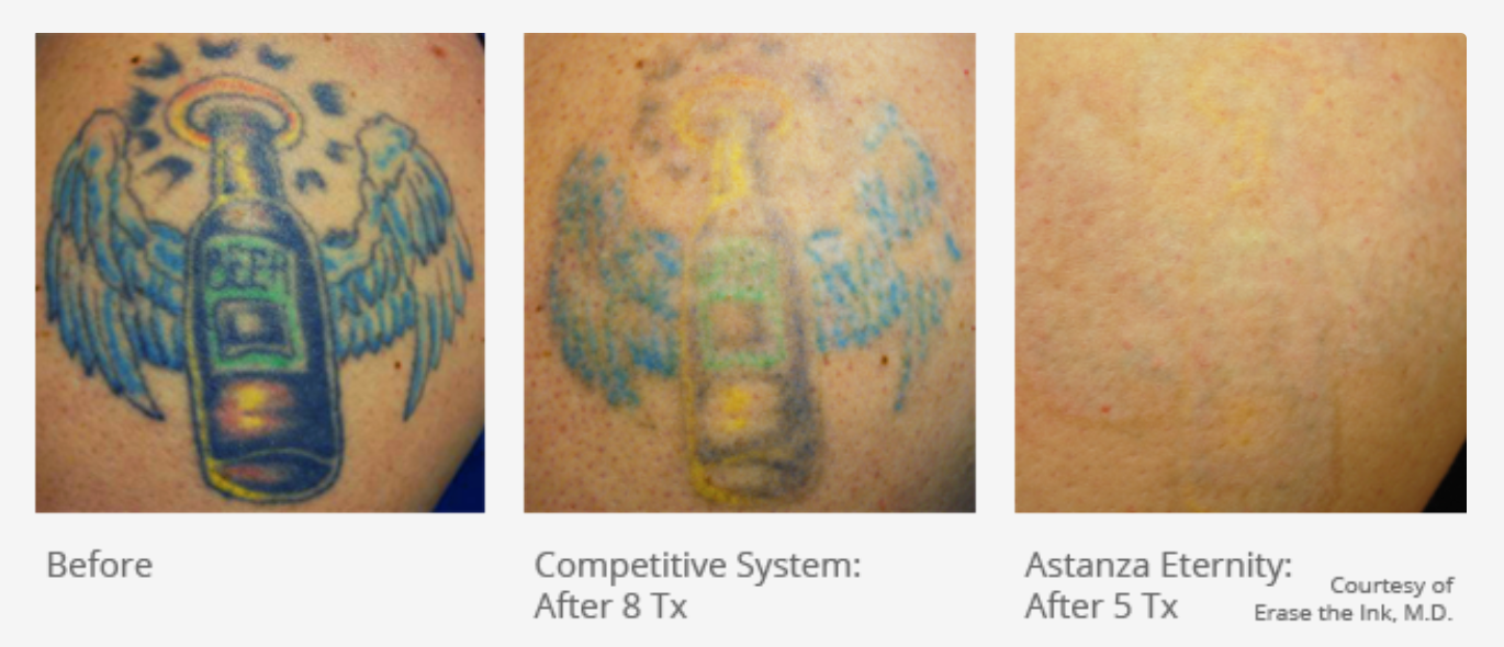 Tattoo Removersink  Arm tattoo removal after 6 treatments Simply click  the book now button to schedule your treatment today Tattoo Removal is our  expertise and specialty Dr Aldridge is number 1