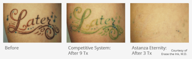 Removing Stubborn Green and Blue Ink with the Astanza EternityTSR Removing Stubborn Green and Blue Ink with the Astanza EternityTSR