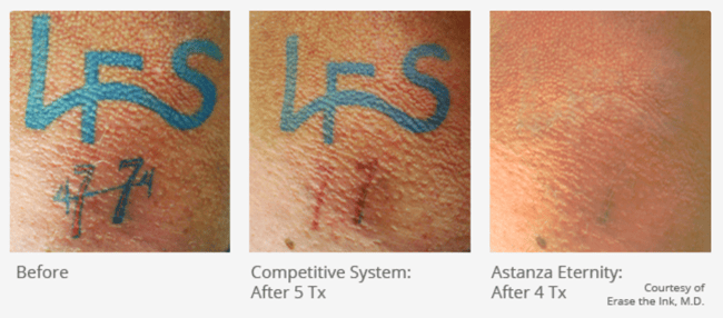 Removing Stubborn Green and Blue Ink with the Astanza EternityTSR