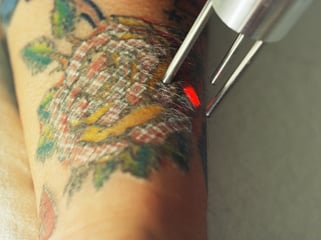 Tattoo Removal 2 web.jpg