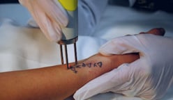 Things-to-Consider-When-Adding-Laser-Tattoo-Removal-to-Your-Business