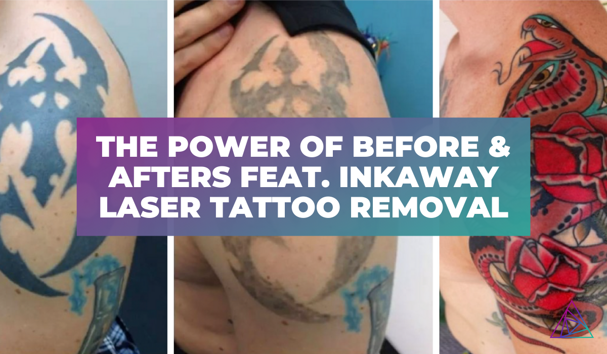 The Power of Before & Afters Feat. InkAway Laser Tattoo Removal