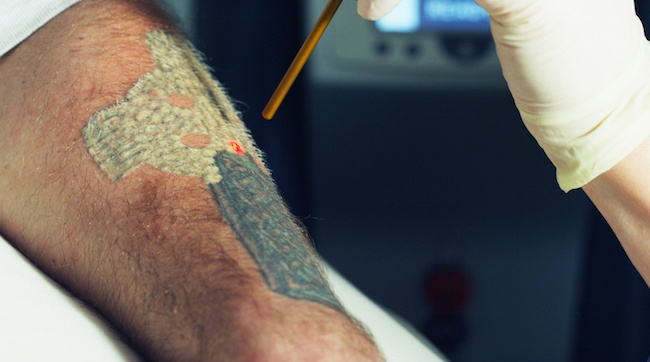 Adding Tattoo Removal to Your Existing Practice